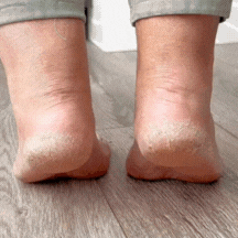 Seidenglatt Pro™ – Hornhaut-Entferner mit 60 Wechselpads (gratis)