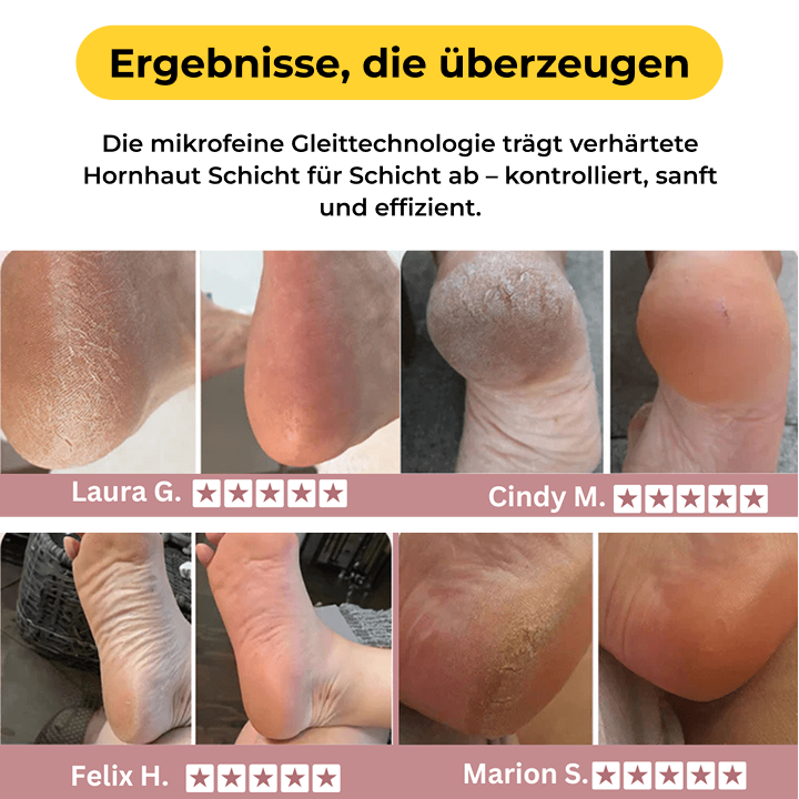 Seidenglatt Pro™ – Hornhaut-Entferner mit 60 Wechselpads (gratis)